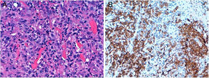 A) Hematoxilina-eosina (40×): destaca la presencia de células grandes pleomórficas de núcleo grande, nucléolo prominente y citoplasma eosinófilo, correspondientes con células linfoides atípicas. B)La práctica totalidad de las células linfoides son positivas para la tinción inmunohistoquímica CD30.