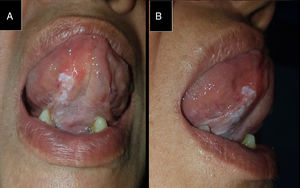 Leucoplasia no homogénea sublingual y áreas parcheadas leucoplásicas en el suelo de la boca anterior y edentulismo parcial. A) Vista frontal. B) Vista lateral.