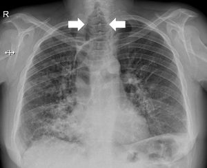 Radiografía de tórax que muestra una traqueobroncomegalia.