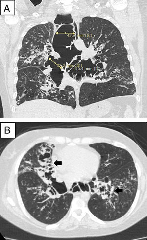 Tomografía computarizada torácica. A) Se evidencia dilatación traqueal y de ambos bronquios fuentes. B) Se muestran dilataciones del árbol bronquial asociadas a bronquiectasias.