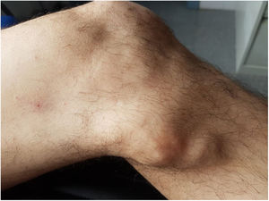 Tumoración en cara interna de la rodilla izquierda: A la palpación se aprecia un nódulo elongado de consistencia dura, no doloroso ni móvil.