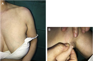 A) Lesión nodular axilar izquierda, de consistencia elástica, móvil, con piel suprayacente normal. B) Salida de material blanquecino no purulento a la expresión suave.