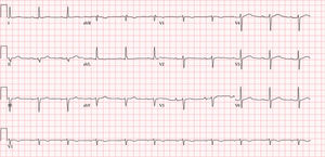 Electrocardiograma con bloqueo auriculoventricular de primer grado con desviación izquierda del eje (−41̊).