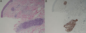 (A) HE, ×10: Vasos linfáticos dilatados en dermis, repletos de células atípicas de aspecto epitelial. (B) TTF1, ×10: La inmunotinción con TTF1 fue positiva en las células del interior de los vasos linfáticos dilatados, así como para napsina A (ambas positivas en el adenocarcinoma de pulmón).