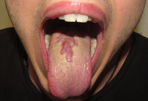 Placa depapilada de bordes geográficos en el dorso de la lengua.