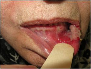 Extensa erosión que afecta a la mucosa del labio inferior, encías y mucosa yugal, con bordes irregulares y cubierto por fina fibrina.