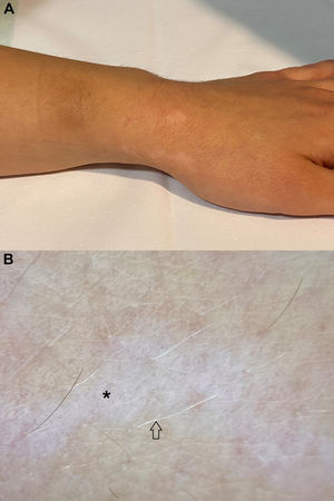 A) En la superficie dorsolateral externa de la muñeca izquierda se muestran máculas hipocrómicas. B) A la dermatoscopia de luz polarizada se identifican áreas blancas sin estructura y puntos negro-grisáceos (*). También se aprecian folículos pilosos de color blanco sobre dichas áreas (flecha).
