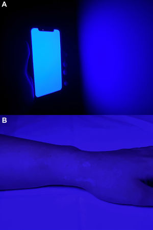 A) Pantalla del dispositivo móvil emitiendo una fuente de luz azul. B) Identificación de las lesiones bajo esta fuente de luz mostrando una fluorescencia blanco-azulada.