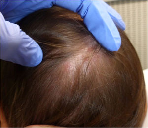 Lesiones eritematodescamativas en el cuero cabelludo, con pústulas aisladas.