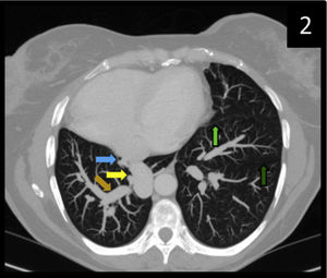Corte transversal de tórax en ventana pulmonar (versión MIP). Apréciese la dextrocardia, la hipoplasia pulmonar derecha y el drenaje pulmonar derecho anómalo (flecha marrón) y la confluencia del tronco pulmonar (flecha amarilla) en la vena cava inferior (flecha azul). Nótese el isomerismo derecho: cisura menor (flecha verde clara) y cisura mayor (verde oscuro).