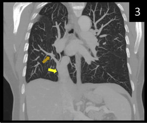 Corte coronal de tórax en la ventana pulmonar (versión MIP). Apréciese hipoplasia pulmonar derecha y drenaje pulmonar derecho anómalo (flecha marrón) y confluencia del tronco pulmonar (flecha amarilla) en la vena cava inferior (no apreciable en este corte).