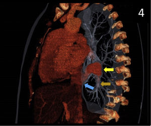 Corte sagital de tórax (reconstrucción volumétrica). Apréciese el drenaje pulmonar derecho anómalo (flecha marrón) y la confluencia del tronco pulmonar (flecha amarilla) en la vena cava inferior (flecha azul).