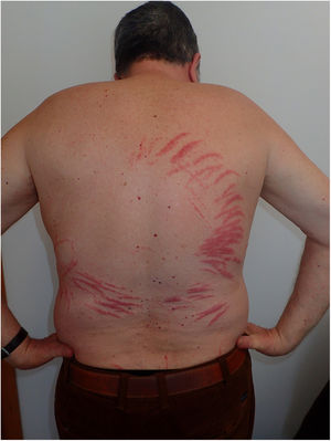Parallel striped whiplash-like erythematoedematous lesions.