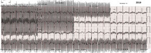Electrocardiograma en el que se observa la distorsión del trazado electrocardiográfico por interferencia con la corriente de estimulación del Barostim.