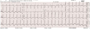 Electrocardiograma previo de noviembre de 2018 con taquicardia sinusal.