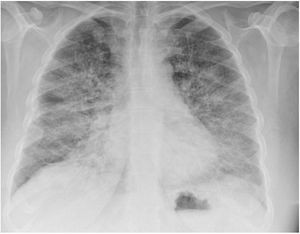 Radiografía de tórax: ICT normal. Infiltrado alveolo-intersticial bilateral de predominio en base derecha de cronología aguda.