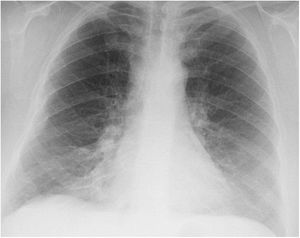 No se evidencian imágenes de condensación, cinco días antes, con relación a la consulta por hiperreactividad bronquial.