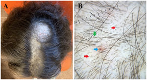 A. Aspecto clínico del cuero cabelludo de la paciente, con mayor afectación frontal y costras hemorrágicas occipitales. B. Detalle tricoscópico. Flecha roja: pelo en «v». Flecha amarilla: pelo enroscado. Flechas verdes: pelos rotos en diferentes alturas.