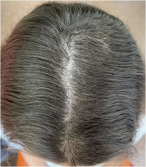 Repoblación del área frontal y occipital, sin áreas de alopecia cicatricial permanente.