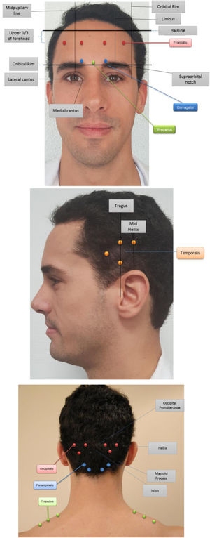 Fixed-site, fixed-dose PREEMPT injection site locations.