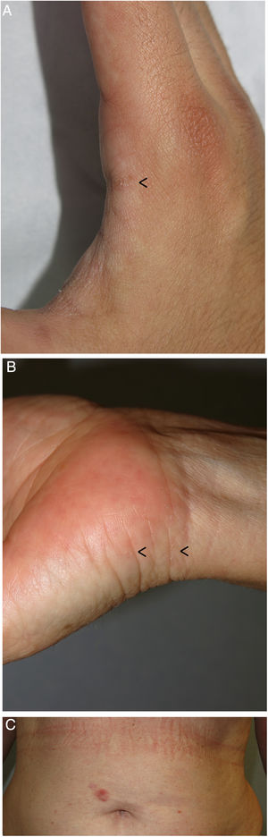 Escabiosis en un adulto. A y B) Surcos acarinos en el primer espacio interdigital de la mano derecha (flecha) (A) y en la muñeca izquierda (flechas) (B). Las localizaciones más frecuentes para encontrar surcos acarinos son las manos, incluyendo los espacios interdigitales, las muñecas y los pies. C) Nódulo escabiótico periumbelical. La paciente refería intenso prurito en la zona. Las localizaciones más frecuentes de los nódulos escabióticos son los genitales, glúteos y zona periumbelical, entre otros.