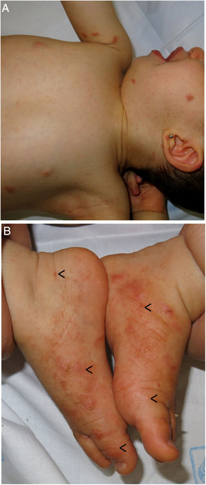 Escabiosis en un lactante de 12 meses. A) Múltiples nódulos escabióticos en el tronco, axilas y en la cara. B) Placas eritematodescamativas, vesículas y surcos acarinos (flechas) en los pies. La paciente había recibido más de 10 aplicaciones de permetrina tópica al 5%, sin respuesta clínica. Se le indicaron un total de 2 dosis de ivermectina oral de 1,5mg (aproximadamente 200μg/kg), separadas por una semana. Presentó una remisión completa durante las siguientes semanas.