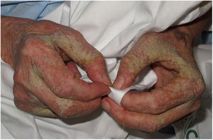 Sarna noruega en una anciana con demencia senil. Placas hiperqueratósicas en ambas manos. La sarna noruega es más frecuente en pacientes con alteraciones neuropsiquiátricas, inmunosuprimidos, hemodializados e individuos con diabetes mellitus, entre otros. En este caso, la paciente recibió 3 dosis de ivermectina oral (200μg/kg) junto con múltiples aplicaciones de permetrina tópica al 5% y de vaselina filante, con respuesta clínica completa. Se indicaron además rigurosas medidas higiénicas y de manejo de fómites, dada la alta probabilidad de contagio.