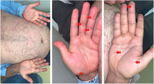 Exantema cutáneo generalizado. A) Pápulas eritematosas induradas (botones), sin tendencia a la agrupación, localizadas fundamentalmente en tronco y tercio proximal de las extremidades, con afectación palmar acompañante. B y C) Detalle de las lesiones palmares, indicativas del proceso y de gran valor semiológico.