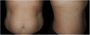 Fotografía clínica de la primera paciente. Exantema maculopapular eritematoso afectando al tronco anterior y lateral.