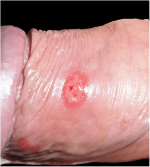 Fotografía clínica del segundo paciente. Úlcera infiltrada no dolorosa en cuerpo de pene.