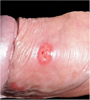 Fotografía clínica del segundo paciente. Úlcera infiltrada no dolorosa en cuerpo de pene.