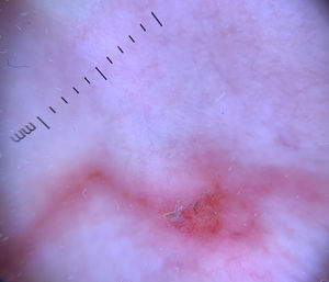 Detalle dermatoscópico. Detalle en el que se observa a mayor aumento el surco labrado por la larva, sin identificarse elementos estructurales parasitarios, con restos textiles en la abrasión cutánea.