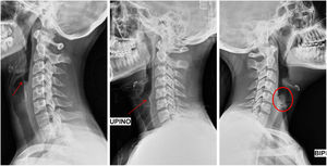Radiografía lateral cuello. Las imágenes a y b son compatibles con la normalidad, observándose una sombra epiglótica, señalada con una flecha, puntiforme o «signo del dedo meñique» (a) o aplanada (b). En c destaca un marcado aumento de la densidad de la región epiglótica o «signo del pulgar», señalado con un círculo.