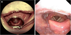 Visión de una epiglotis sana a través de una laringoscopia indirecta (a)*, comparada con la visión a través de una rinofibrolaringoscopia directa de una epiglotis edematosa e inflamada diagnóstica de epiglotitis, comprobando la permeabilidad de la vía aérea (b). *Remacle M, Lawson G, Giovanni A, Woisard V. Exploración de la laringe. EMC-Otorrinolaringologia. 2006;35:1-15. Disponible en: https://doi.org/10.1016/S1632-3475(06)45293-0.