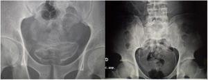 Ejemplos de calcificaciones vesicales secundarias a esquistosomiasis.