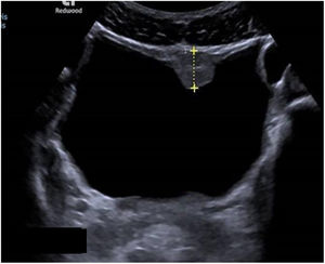 Nódulo vesical (bilharzioma) secundario a esquistosomiasis por S. haematobium.