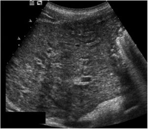 Fibrosis hepática periportal secundaria a esquistosomiasis por S. mansoni.