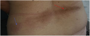Corresponde a la lesión de aparición inicial en región lumbar. En esta se puede apreciar cómo la zona central lumbar (flecha a la derecha de la imagen) es de color marronácea, y en la zona más periférica izquierda (flecha a la izquierda de la imagen) se ve una mancha de color rosa-lila más eritematosa que correspondería evolutivamente a una lesión más reciente y activa.