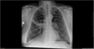 Rx de tórax PA: imagen de densidad aumentada biconvexa a nivel de la cisura menor pulmonar con borramiento de la silueta cardiaca derecha y aumento del tamaño del hilio.