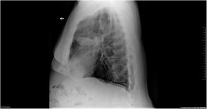 Rx de tórax lateral: atelectasia del lóbulo medio pulmonar derecho.