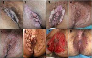 1-6: fotografías realizadas por el paciente sobre la evolución progresiva de la úlcera; 7: fotografía realizada tras la pauta de curas en el hospital, previo al injerto; 8: fotografía 7 días tras el injerto de piel mallada.