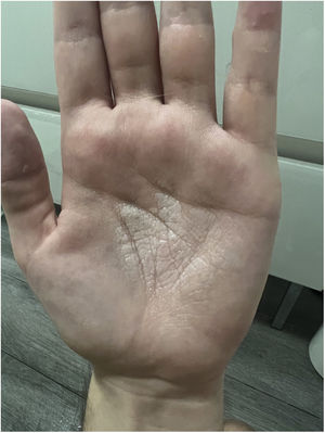 A. Lesiones típicas de la queratodermia acuagénica que afectan las palmas, con el característico aspecto en empedrado macerado. B. Resolución de las lesiones con descamación palmar residual.