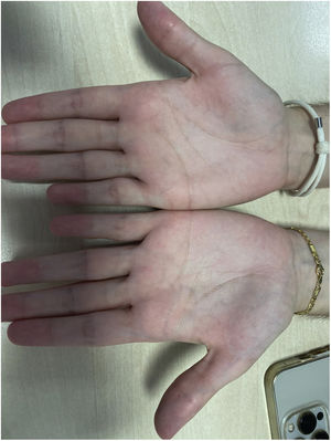 A. Lesiones típicas de la queratodermia acuagénica que afectan las palmas, con el característico aspecto en empedrado macerado. B. Resolución de las lesiones con descamación palmar residual.