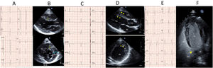Pruebas de casos diagnosticados: A y B) miocardiopatía hipertrófica; C y D) síndrome del QT largo con miocardiopatía espongiforme; E y F) foramen oval permeable.