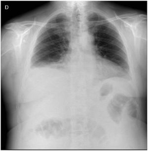 Radiografía postero-anterior de tórax donde se observa mínimo derrame pleural a nivel basal derecho, sin otras alteraciones asociadas.