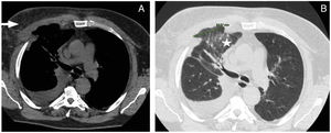 A) Corte sagital angio-TC de tórax donde se objetiva mínimo derrame pleural derecho, asociado con defecto de continuidad a nivel de arcos costales y edematización de tejido muscular y subcutáneo (flecha). B) Corte sagital angio-TC de tórax observando la herniación del parénquima pulmonar junto con infiltrado asociado (estrella).
