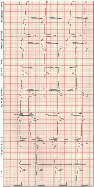 ECG del síndrome de WPW con EV, espacio PR corto con onda delta.
