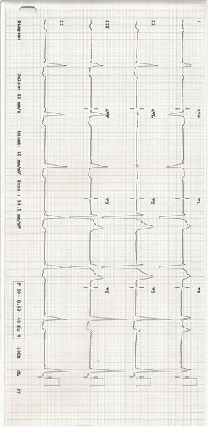ECG del síndrome de WPW con espacio PR corto, QRS ancho y onda delta.