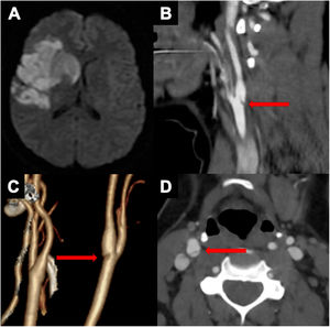 (A) Diffusion-weighted magnetic resonance imaging shows an infarction in the frontal and temporal lobes, also affecting the basal ganglia. (B and D) Computed tomography angiography demonstrates a thin intraluminal filling defect (arrow) along the posterior wall of the right carotid bulb which appeared as a septum on axial image. (C) A postero-lateral view of the 3D reconstruction computed tomography angiography shows the web like an indentation of the carotid wall.