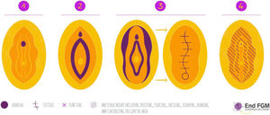Tipos de MGF; Tipo 1: clitoridectomía; Tipo 2: clitoridectomía y excisión de labios; Tipo 3: infibulación, y Tipo 4: otras prácticas. Fuente: End FGM. European Network15.